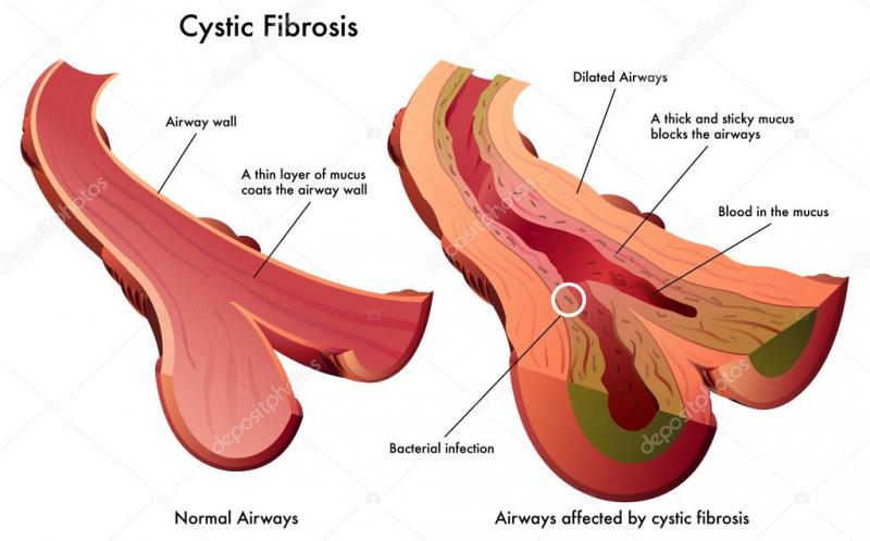 Fibrozis